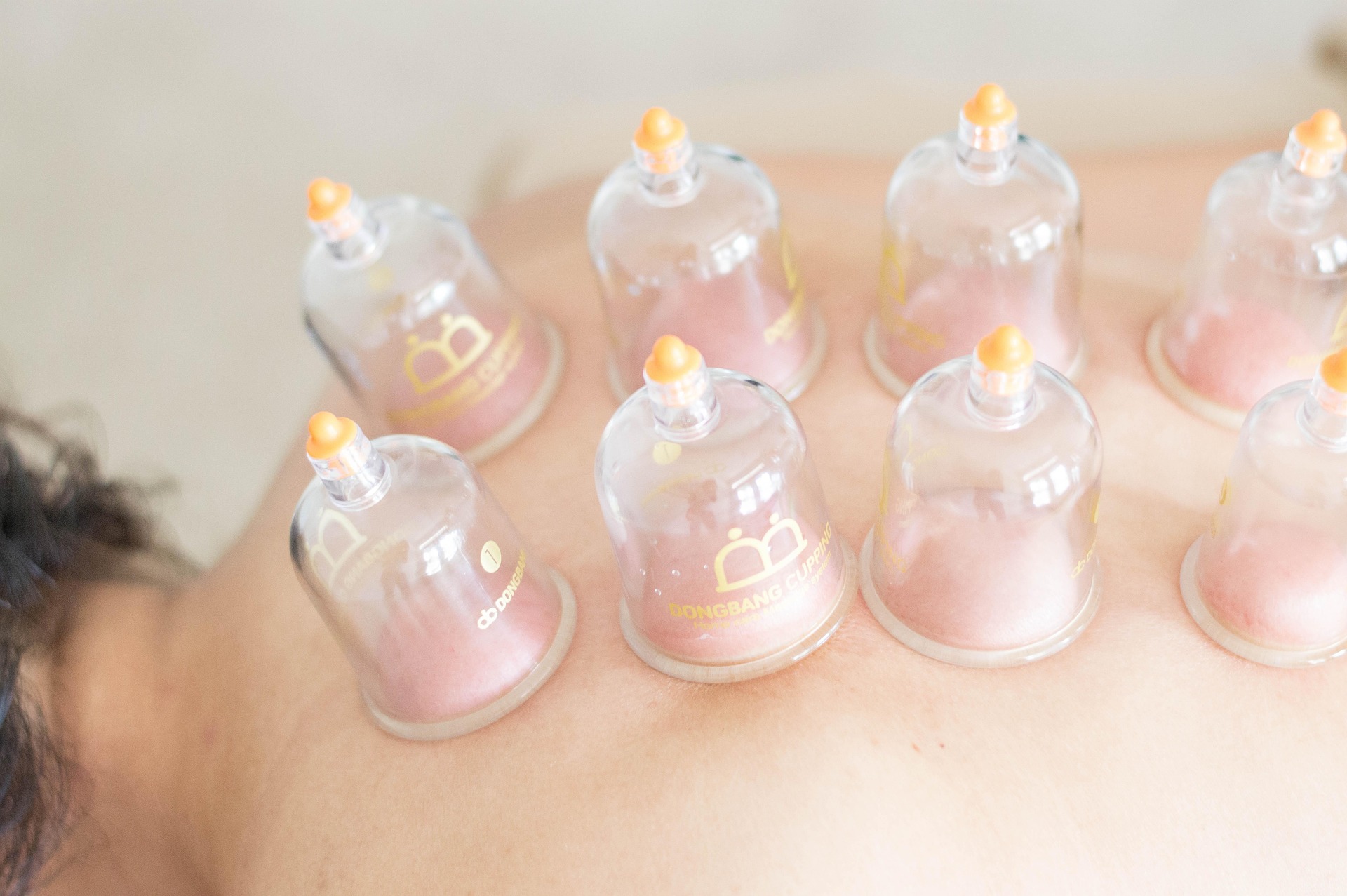 cupping-therapy 1
